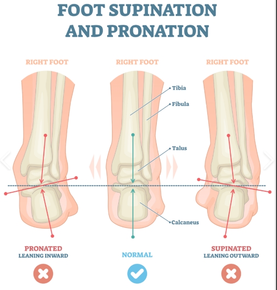 BÀN CHÂN BẸT LÀ GÌ? KHI NÀO CẦN CAN THIỆP?